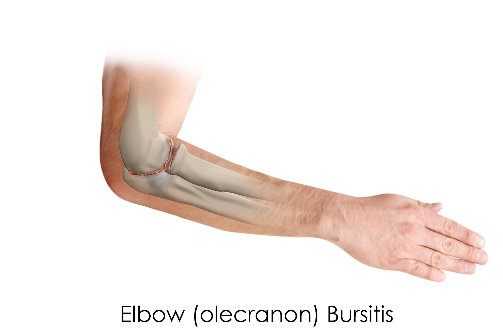Osteoarthritis Of The Elbow