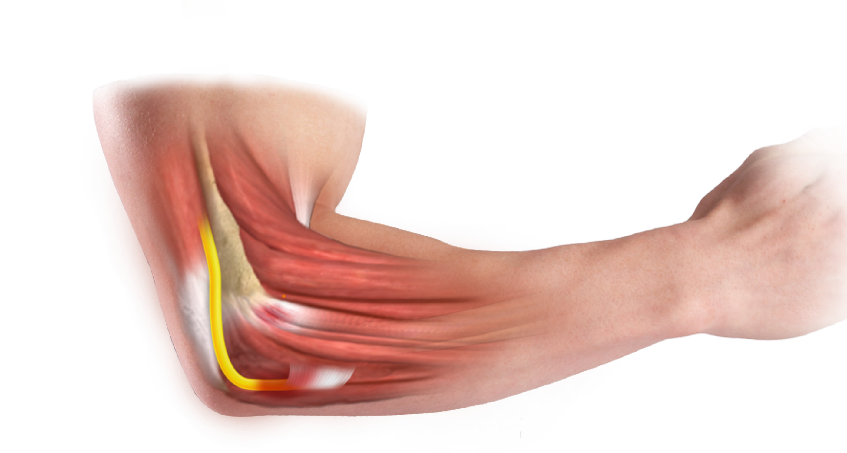ulnar tunnel syndrome